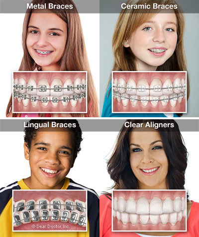 Orthodontic Appliance Options.