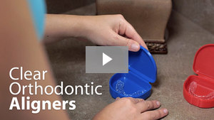 Clear Orthodontic Aligners Video